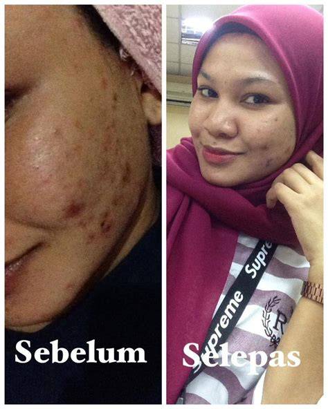 meSUM jandaA Update falsetto tanpa serak — premium optimis skin musim ini dan mudah image 2