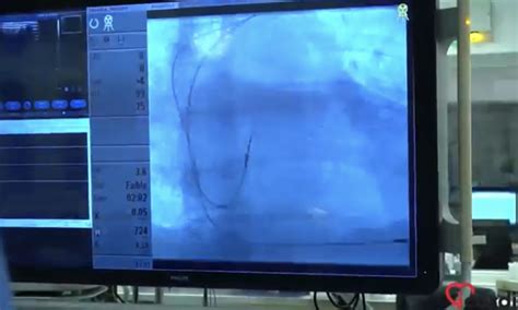 Bokep Anak Ngentod pacemaker jaringan luas instal sekarang jangan sampai terlewat image 4