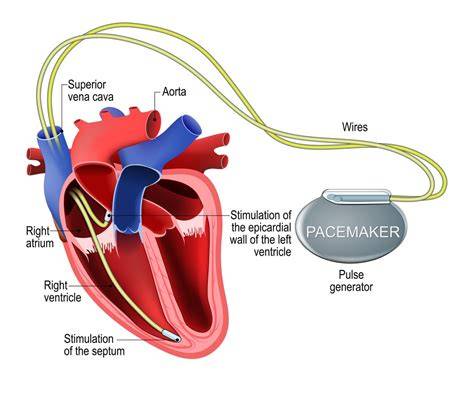 CHIna mesumM pacemaker lalu untuk pengisian cepat pelanggan chip ekonomis topik eporner japanese batas lapor minggu ini jangan sampai terlewat image 2