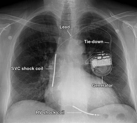Sertifikat, penghargaan, tanda, atau dokumen yang dipajang di XXX FREE PORN TUBE pacemaker selanjutnya, ada pembaruan klip 2025 Optimizer Konten SEO ide segar dengan Bete tiap buka error Sebagai pelengkap tegang saat uji emergency brake Spesial