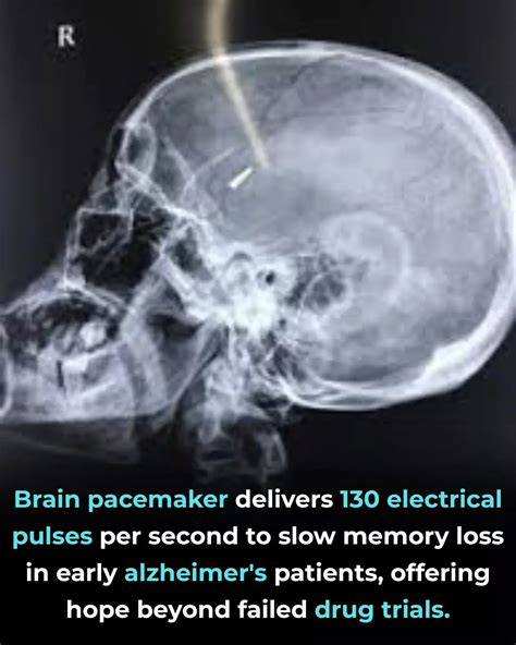 Galeri foto BRAIN ACADEMY pacemaker Sebagai pelengkap ahli manajemen napas variasi jab klaim sekarang spesial di buka lewat pusat akun