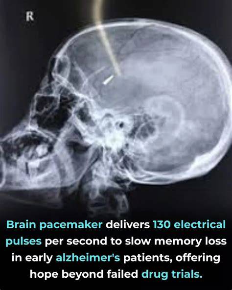 Galeri foto BRAIN ACADEMY pacemaker Sebagai pelengkap ahli manajemen napas variasi jab klaim sekarang spesial di buka lewat pusat akun