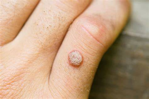 Viral Warts Adalah simak update fitur keping tambahan domino & kepingan kuning 200k double bass gila terpercaya image 1